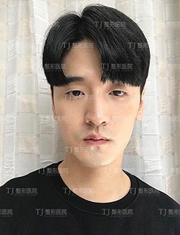 -韩国TJ整形外科男生“模板”整形案例公布！