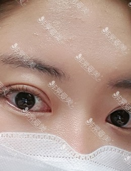 韩国yellow埋线双眼皮手术案例_术后