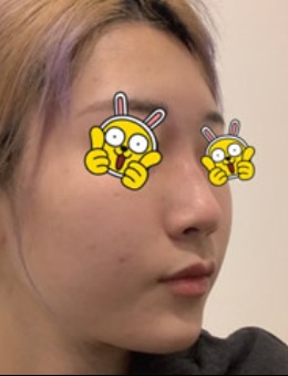 韩国Ucanb整形外科驼峰鼻矫正真人案例对比！
