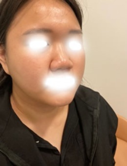 韩国Ucanb整形外科鼻翼缩小案例展示！