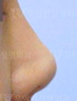 韩国优雅人整形外科鼻修复真人案例对比！_术前