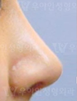 韩国优雅人整形外科鼻修复真人案例对比！_术后