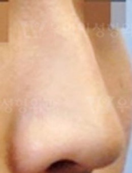 -韩国优雅人整形外科硅胶+耳软骨隆鼻真人案例！