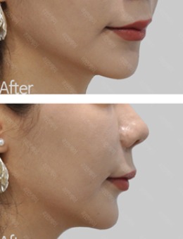韩国丽妍K整形皮肤科面部提升真人案例对比！
