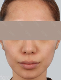 韩国丽妍K整形皮肤科面部脂肪填充真人案例对比！