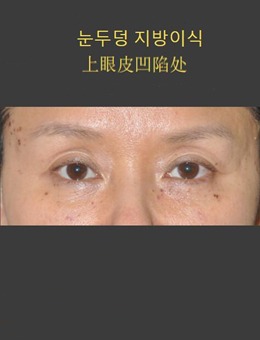 上眼皮凹陷可以填充脂肪！我在韩国will整形医院做的挺成功的！