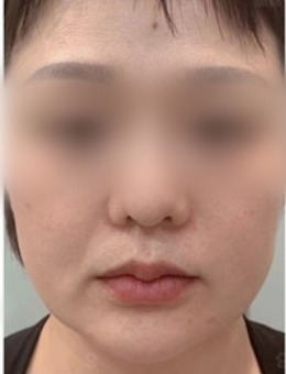 临沂星铄医疗美容医院面部提升案例