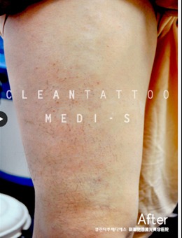 科琳挞图激光美容医院腿部激光洗纹身前后对比照片