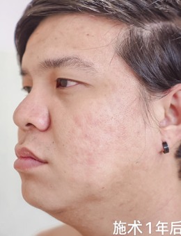 韩国陈整形外科治疗面部痘坑一年后效果展示！_术后