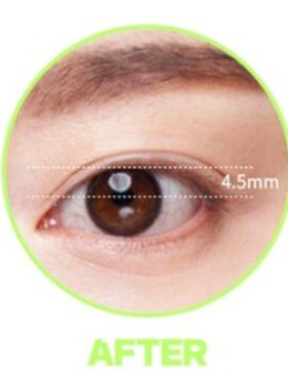 韩国大眼睛整形医院双眼皮案例