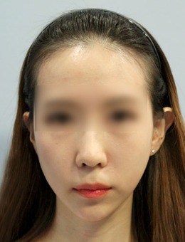 -韩国V-fix面部抗衰老提升案例