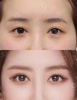 韩国爱她整形医院双眼皮+隆鼻综合整形案例