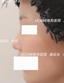 -韩国Ucanb鼻综合整形手术案例
