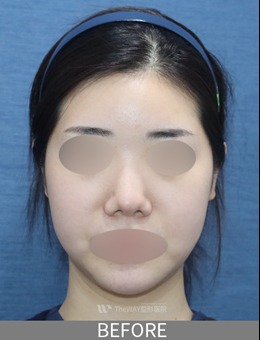 韩国TheWAY整形外科面部吸脂+埋线提升案例