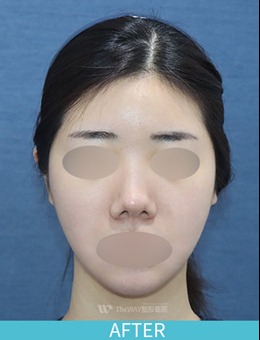 韩国TheWAY整形外科面部吸脂+埋线提升案例