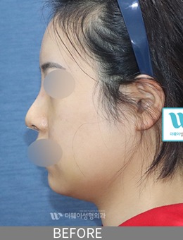 韩国TheWAY整形医院鼻中隔+歪鼻+蒜头鼻矫正案例