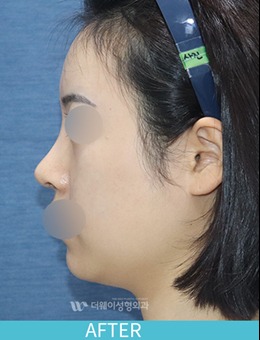 韩国TheWAY整形医院鼻中隔+歪鼻+蒜头鼻矫正案例