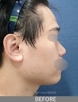 韩国TheWAY整形医院男士蒜头鼻整形前后对比照片