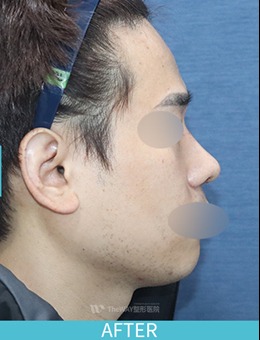 韩国TheWAY整形医院男士蒜头鼻整形前后对比照片_术后