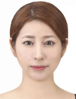 韩国大眼睛整形外科祛黑眼圈案例_术后
