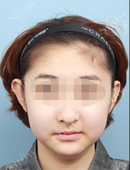 -韩国SNOW整形外科嘴角、下颌缘和双下巴吸脂效果图