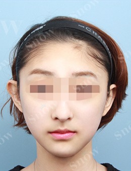 韩国SNOW整形外科嘴角、下颌缘和双下巴吸脂效果图