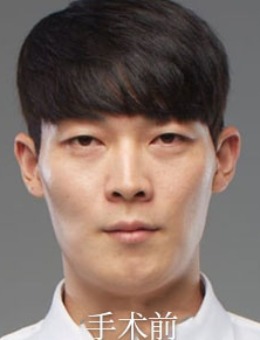 -韩国齐娥男士面部轮廓整形案例图片