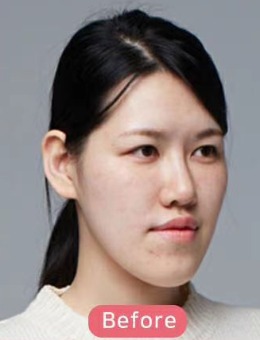 韩国齐娥牙科双鄂+轮廓三件套手术前后对比图
