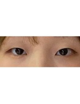 -韩国大眼睛整形双眼皮案例