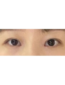 -韩国大眼睛整形双眼皮案例