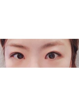 -韩国大眼睛整形窄双眼皮手术案例