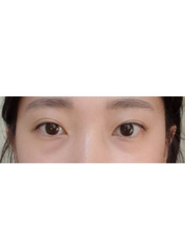 韩国去黑眼圈+眼底脂肪重置术案例照片