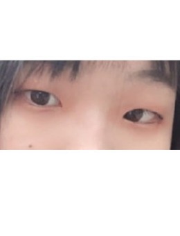 -韩国双眼皮手术案例照片