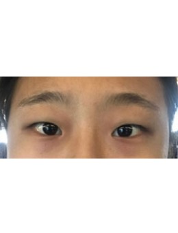 韩国埋线双眼皮+开眼角手术案例_术前
