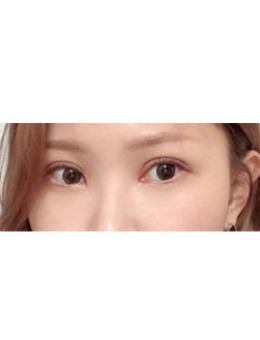 韩国大眼睛医院双眼皮手术案例