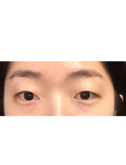 韩国双眼皮手术案例照片_术前