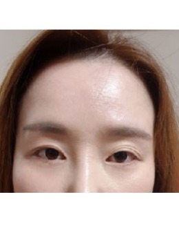 韩国双眼皮失败修复+眼形矫正案例对比图