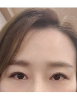 韩国双眼皮失败修复+眼形矫正案例对比图_术后