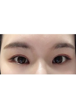 韩国疤痕体质双眼皮+开眼角案例