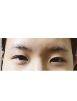 韩国疤痕体质双眼皮+开眼角案例