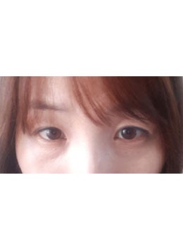 韩国大眼睛整形医院双眼皮+去眼袋案例