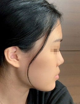 韩式S型隆鼻线条整形案例图片