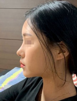 -韩式S型隆鼻线条整形案例图片