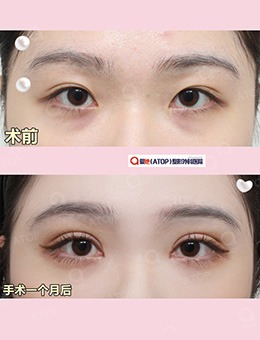 -韩国爱她整形医院双眼皮整形一个月改善效果图