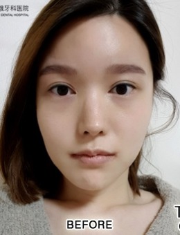 双鄂正颌手术恢复后什么样？看齐娥牙科韩系女孩的案例对比！