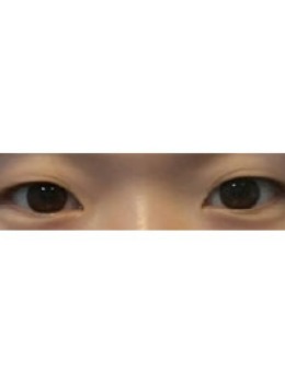 -韩国大眼睛整形外科埋线双眼皮日记