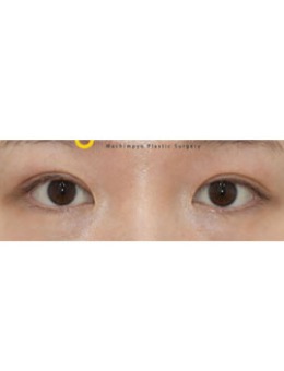 韩国双眼皮宽变窄对比案例
