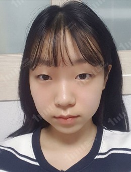 韩国1mm亲妈款双眼皮手术案例