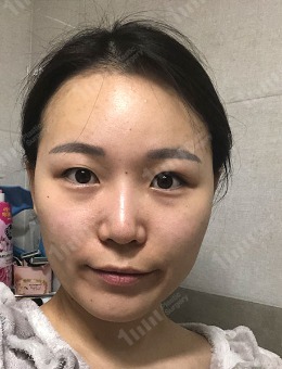 -韩国1mm整形双眼皮窄变宽手术案例