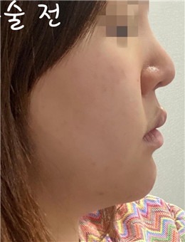 YJ整形外科鼻修复+面部脂肪填充术后1个月真人案例图_术前